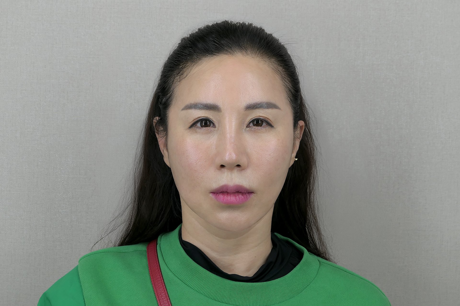 수술 후